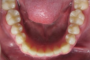 shifted teeth corrected