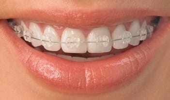 clear braces for kids and adults